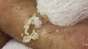 Чистка лица от угрей и акне. Выдавливание прыщей. Удаление черных точек и комедонов