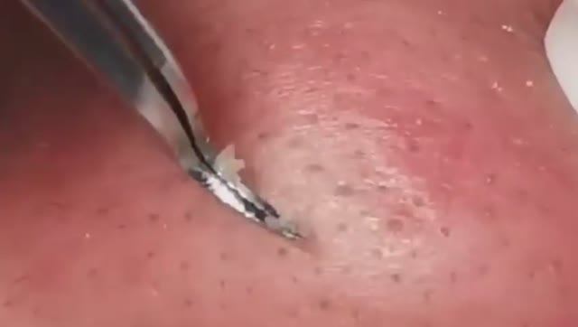 Чистка лица от угрей и акне. Выдавливание прыщей. Удаление черных точек и комедонов смотреть онлайн