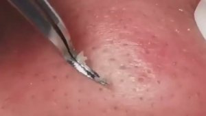 Чистка лица от угрей и акне. Выдавливание прыщей. Удаление черных точек и комедонов