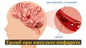 Как удаляют тромб при инсульте? Сложно ли стать и быть врачом?