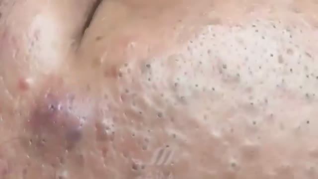 2 часа нежного удаления кистозных прыщей, черных точек и комедонов смотреть онлайн