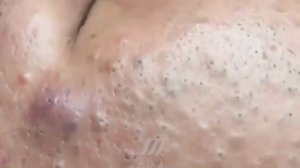 2 часа нежного удаления кистозных прыщей, черных точек и комедонов