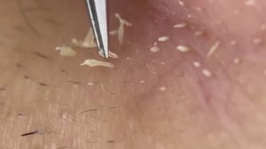 #103 Чистка лица от угрей и акне. Выдавливание прыщей. Удаление черных точек и комедонов