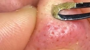 Чистка лица от угрей и акне. Выдавливание прыщей. Удаление черных точек и комедонов