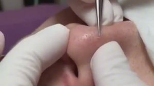 Чистка лица от угрей и акне. Выдавливание прыщей. Удаление черных точек и комедонов