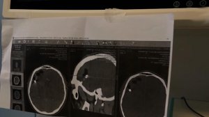 Хирурги удалили осколок из мозга бойца СВО с помощью "умных" очков