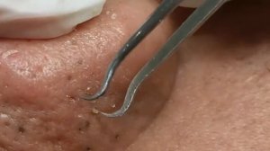 Чистка лица от угрей и акне. Выдавливание прыщей. Удаление черных точек и комедонов