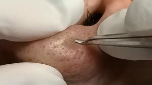 Чистка лица от угрей и акне. Выдавливание прыщей. Удаление черных точек и комедонов