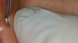 Чистка лица от угрей и акне. Выдавливание прыщей. Удаление черных точек и комедонов