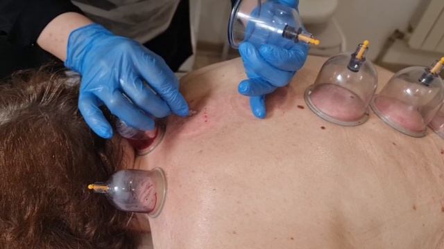 Капиллярное кровопускание! ( Хиджама ) смотреть онлайн