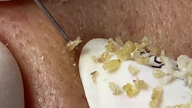 Выдавливание прыщей, угрей, черных точек и камедонов #191 смотреть онлайн