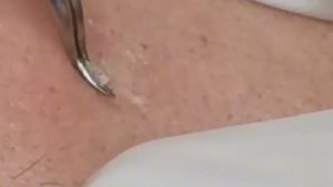 Чистка лица от угрей и акне. Выдавливание прыщей. Удаление черных точек и комедонов