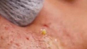 Чистка лица от угрей и акне. Выдавливание прыщей. Удаление черных точек и комедонов