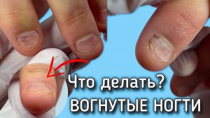 СПАСЕНИЕ ногтей девушки грызуна ❤️ в конце результат через 2 недели