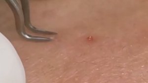 Чистка лица от угрей и акне. Выдавливание прыщей. Удаление черных точек и комедонов