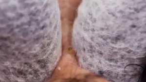 Чистка лица от угрей и акне. Выдавливание прыщей. Удаление черных точек и комедонов