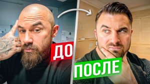 ПЕРЕСАДКА МЕНЯЕТ ЖИЗНЬ! ДО/ПОСЛЕ ПЕРЕСАДКИ ВОЛОС