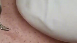 Чистка лица от угрей и акне. Выдавливание прыщей. Удаление черных точек и комедонов