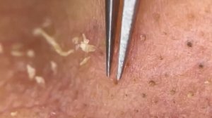 Чистка лица от угрей и акне. Выдавливание прыщей. Удаление черных точек и комедонов