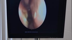 Септопластика и вазотомия результат через месяц.Искривление перегородки носа КТ- результат операции