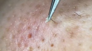 Чистка лица от угрей и акне. Выдавливание прыщей. Удаление черных точек и комедонов