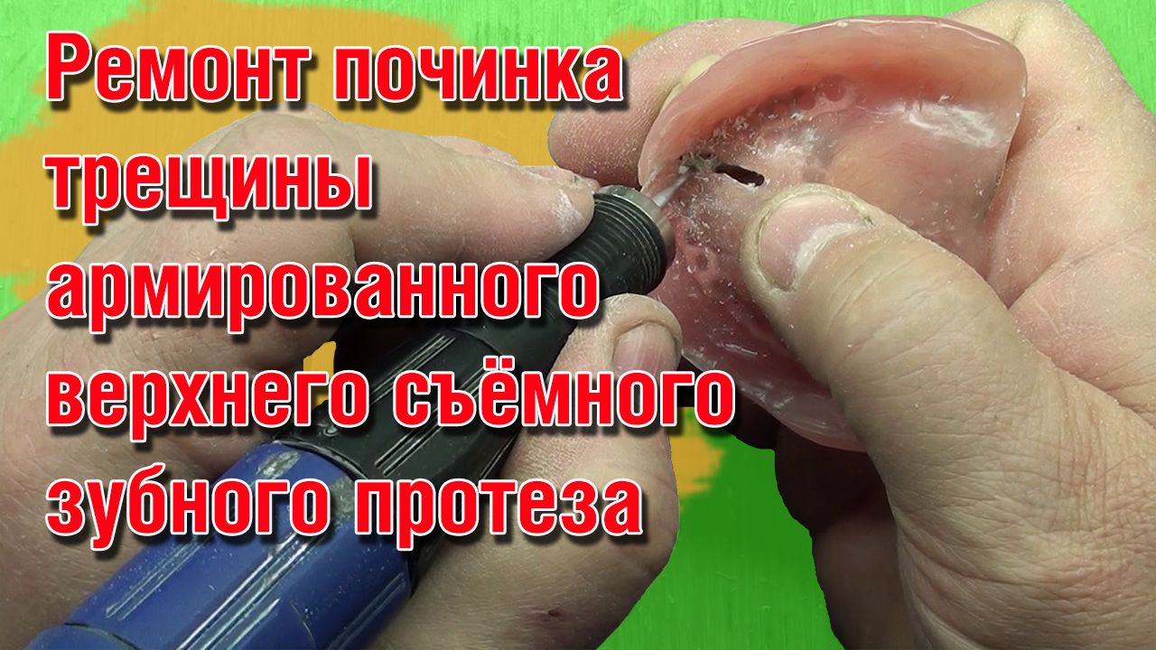 Ремонт починка трещины армированного верхнего съёмного зубного протеза смотреть онлайн
