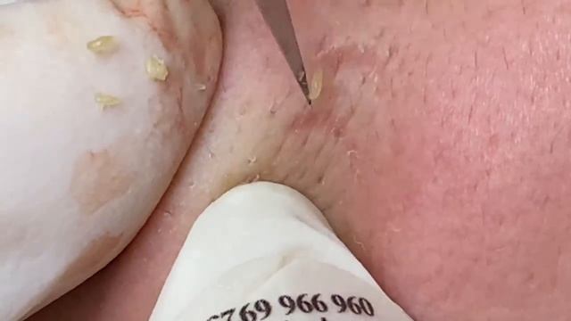 Выдавливание прыщей, угрей, черных точек и камедонов #196 смотреть онлайн