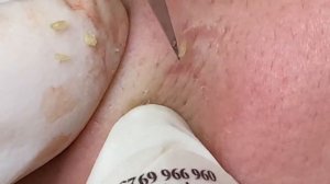 Выдавливание прыщей, угрей, черных точек и камедонов #196