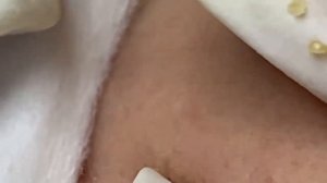 Выдавливание прыщей, угрей, черных точек и камедонов #194