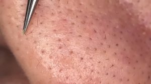 Чистка лица от угрей и акне. Выдавливание прыщей. Удаление черных точек и комедонов