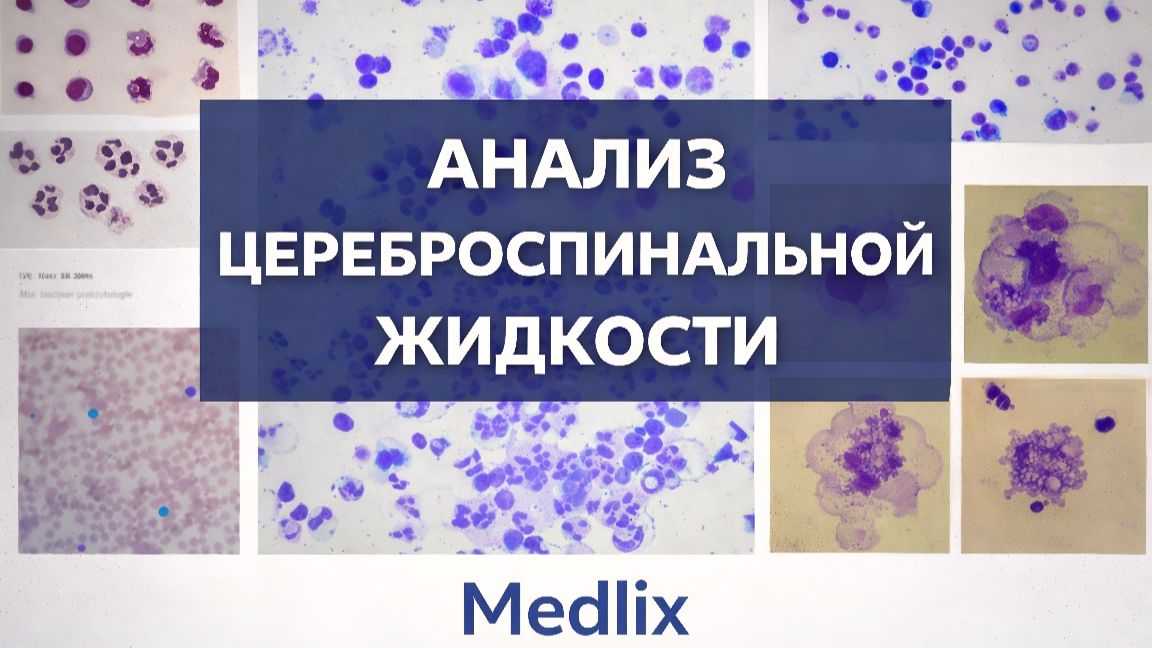 «Анализ цереброспинальной жидкости как координирующий (интегративный) инструмент диагностики» смотреть онлайн