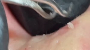 Чистка лица от угрей и акне. Выдавливание прыщей. Удаление черных точек и комедонов