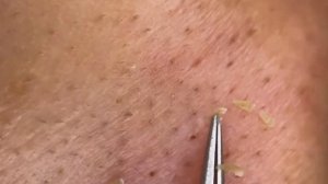 Чистка лица от угрей и акне. Выдавливание прыщей. Удаление черных точек и комедонов