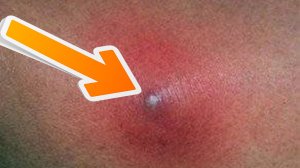 Выдавливание прыщей  и черных точек на лице релакс 2026