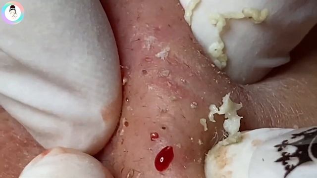 Выдавливание прыщей, удаление жирных прыщей на щеке смотреть онлайн