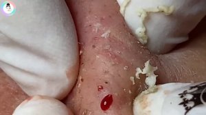 Выдавливание прыщей, удаление жирных прыщей на щеке