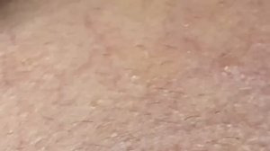 Выдавливание прыщей, угрей, черных точек и камедонов #197