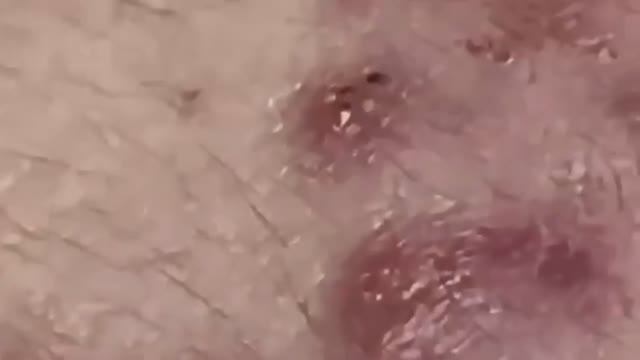 Кожный детокс: освобождение от акне и комедонов смотреть онлайн