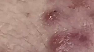 Кожный детокс: освобождение от акне и комедонов