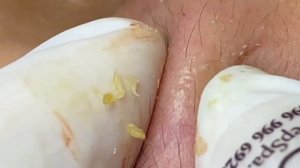 Выдавливание прыщей, угрей, черных точек и камедонов #201