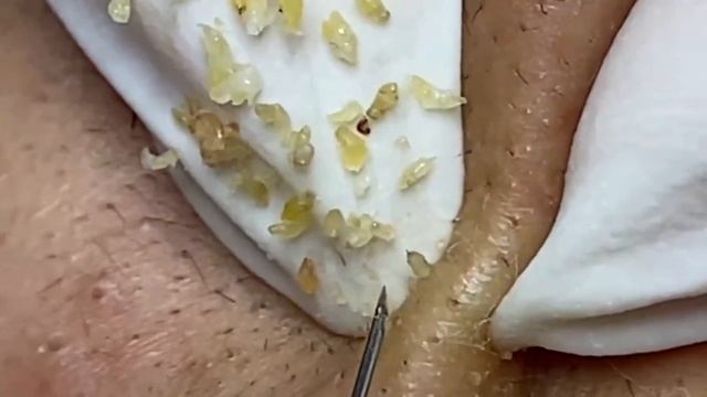 Выдавливание прыщей, угрей, черных точек и камедонов #200 смотреть онлайн