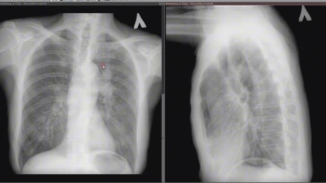 Центральный рак легкого — разбор случая Центральный рак легкого — разбор случая