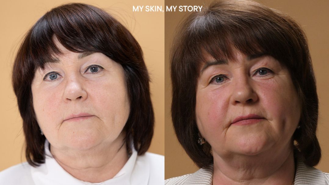 BABOR_MY SKIN, MY STORY: как убрать мимические морщины, сухость и второй подбородок после 58 лет