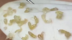 Выдавливание прыщей, угрей, черных точек и камедонов #198