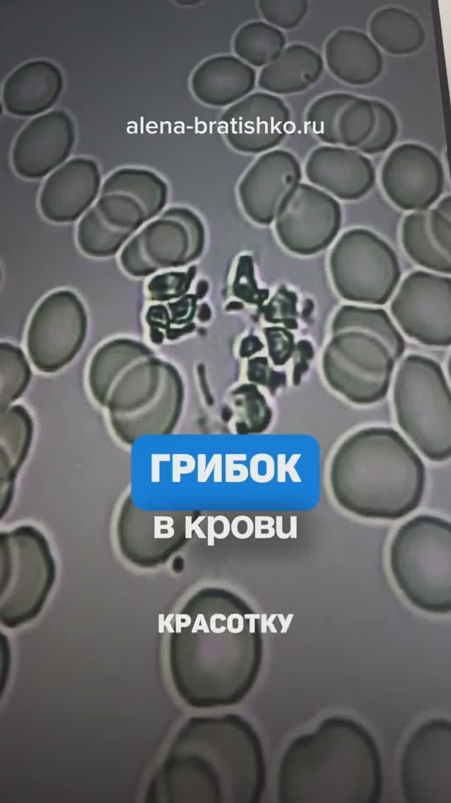 Грибок в крови. Семейный доктор Алена Братишко