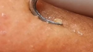 Чистка лица от угрей и акне. Выдавливание прыщей. Удаление черных точек и комедонов