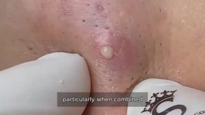 Asmr. Чистим черные точки и прыщи. #10015869