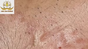 Глубокая чистка: как чистим кожу от комедонов #002