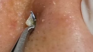 Чистка лица от угрей и акне. Выдавливание прыщей. Удаление черных точек и комедонов