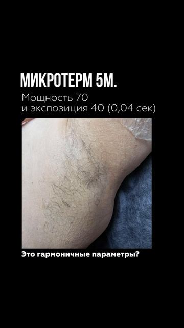 Подмышка  #электроэпиляция #эпиляция #онлайн #обучение #онлайнобучение #курсы #бьюти #лицо #волосы
